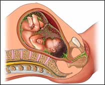 Bacteria in the vagina infects the amniotic fluid surrounding the baby