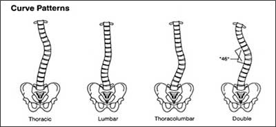 thoracic is a curve in the upper middle of the spine, lumbar is a curve in the bottom, thoracolumbar is in the lower central part, and double is two curves