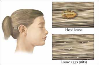 an illustration showing a head louse and louse eggs (nits) in a child's hair