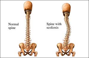 an illustration of a normal (straight) spine and a curved spine